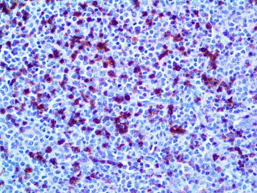 IHC of CD2 on an FFPE T-Cell Lymphoma Tissue